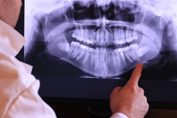 Best Emergency Tooth Extraction in Perryville, MD